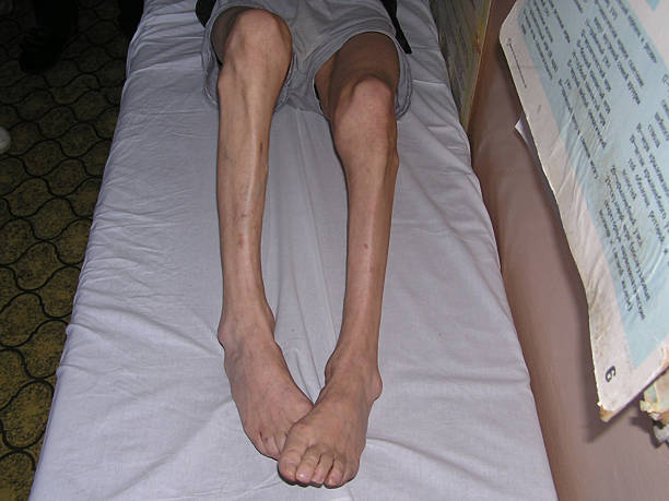 Nerve and Muscle Wasting Treatment in Agra - Dr Vinay Agrawal